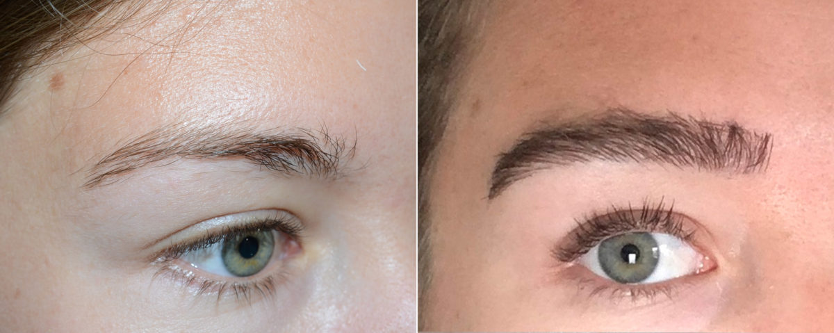 Eyebrow Before and after in Miami, FL, Paciente 117794