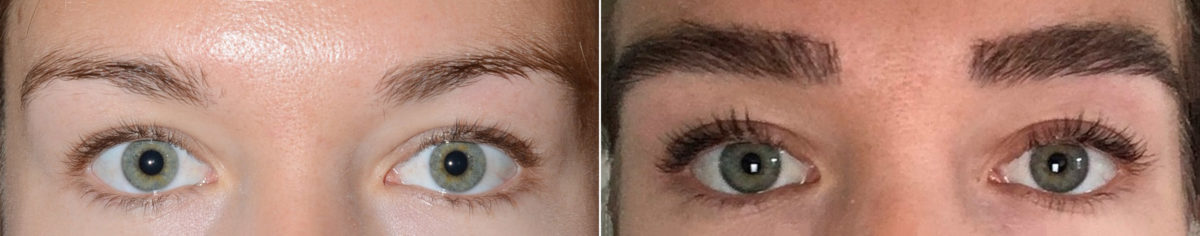 Eyebrow Hair Transplant Before and after in Miami, FL, Paciente 117794