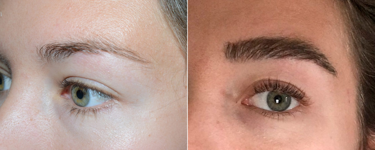 Eyebrow Before and after in Miami, FL, Paciente 117794