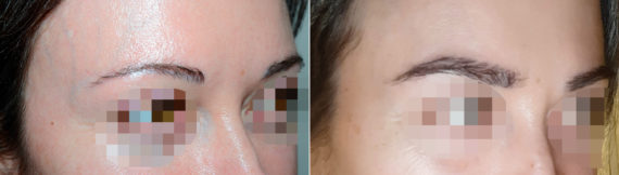 Eyebrow Before and after in Miami, FL, Paciente 117416