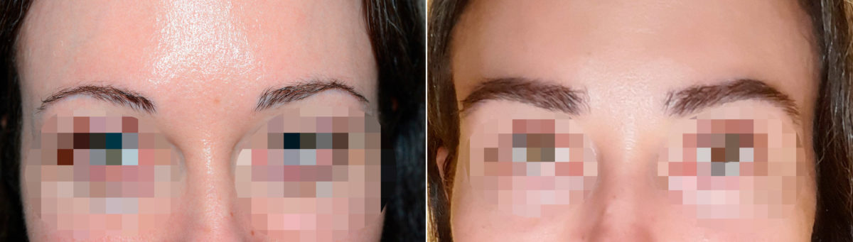 Eyebrow Before and after in Miami, FL, Paciente 117416