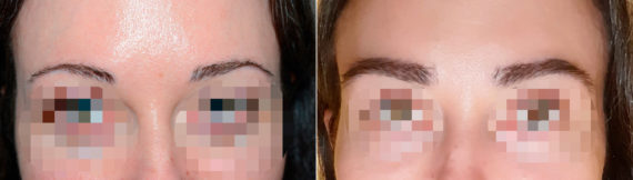 Eyebrow Hair Transplant Before and after in Miami, FL, Paciente 117416