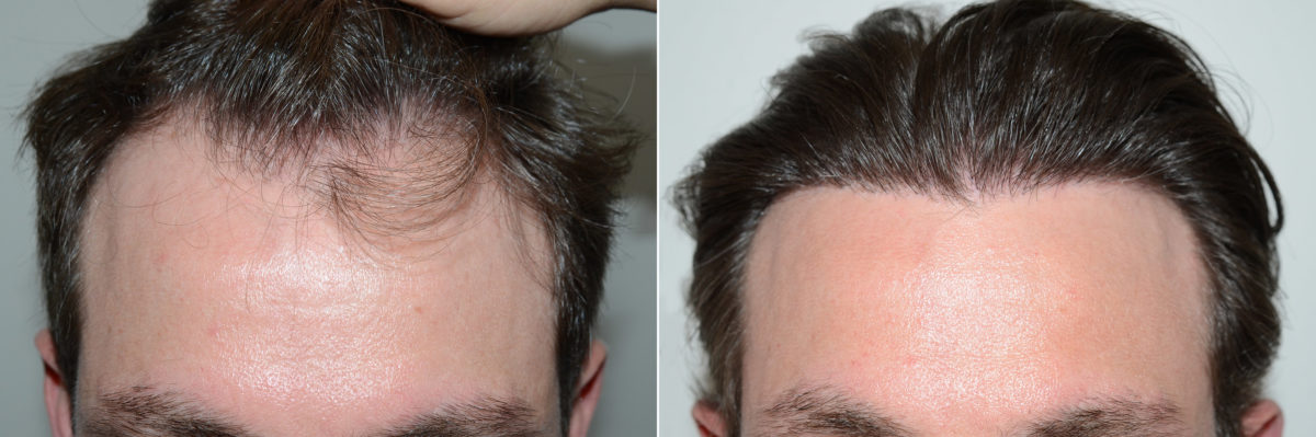 Hair Transplants for Men Before and after in Miami, FL, Paciente 117491