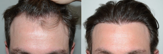 Hair Transplants for Men Before and After Photos - Page 3 of 49 -  Foundation For Hair Restoration