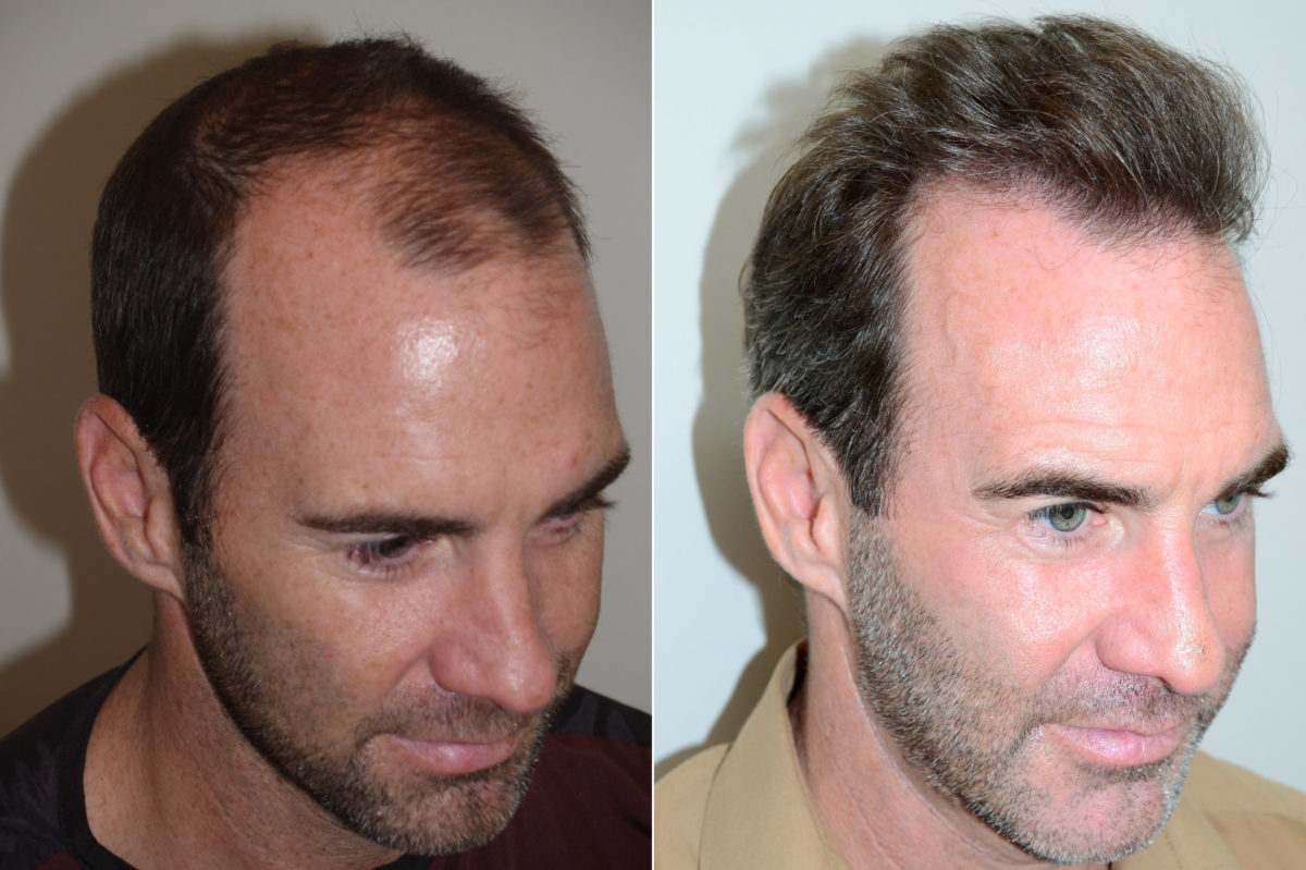 Hair Transplants for Men Before and after in Miami, FL, Paciente 117518