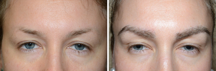Eyebrow Hair Transplant Before and after in Miami, FL, Paciente 35654
