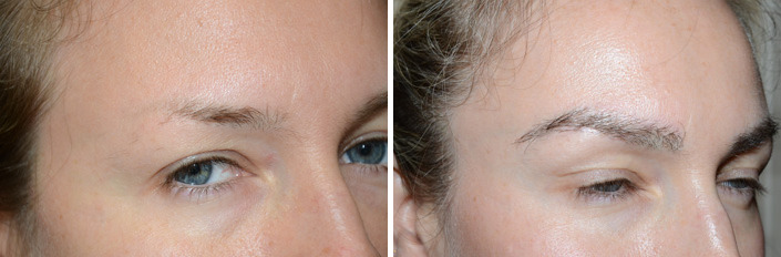 Eyebrow Before and after in Miami, FL, Paciente 35654