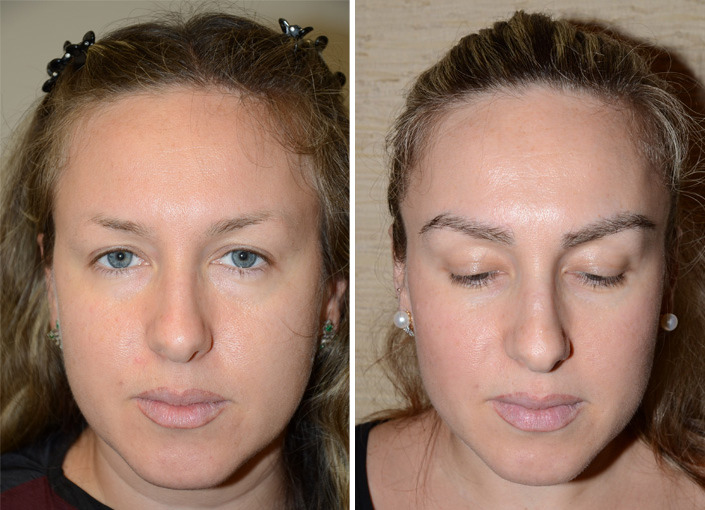 Eyebrow Hair Transplant Before and after in Miami, FL, Paciente 35654