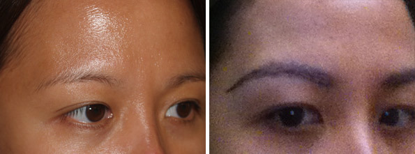 Eyebrow Before and after in Miami, FL, Paciente 35752