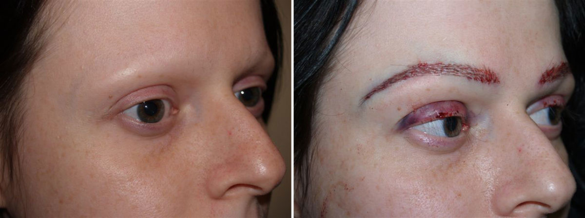 Eyebrow Before and after in Miami, FL, Paciente 35990