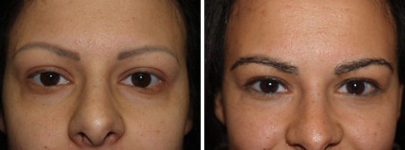 Eyebrow Hair Transplant Before and after in Miami, FL, Paciente 36007