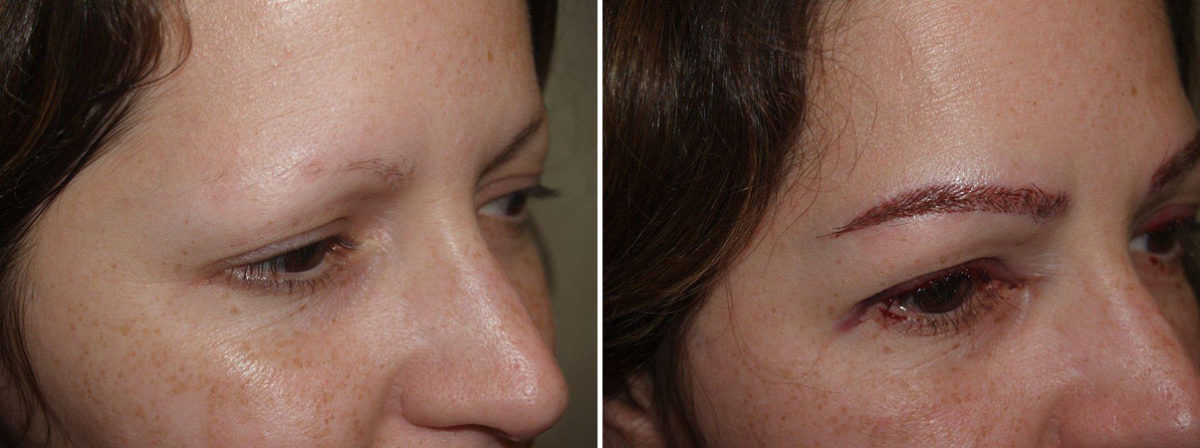 Eyebrow Before and after in Miami, FL, Paciente 36308