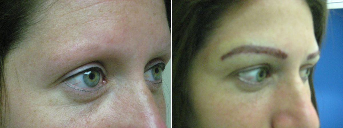 Eyebrow Before and after in Miami, FL, Paciente 36326