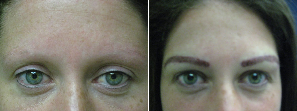Eyebrow Hair Transplant Before and after in Miami, FL, Paciente 36326