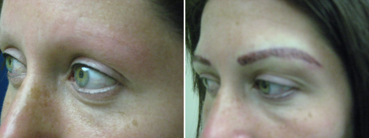Eyebrow Before and after in Miami, FL, Paciente 36326