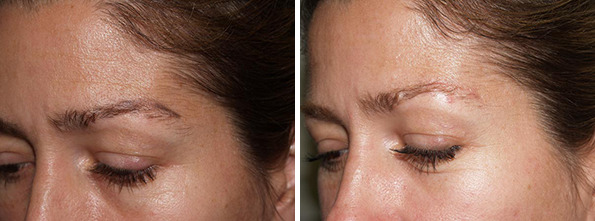 Eyebrow Before and after in Miami, FL, Paciente 36533