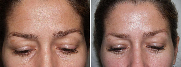 Eyebrow Hair Transplant Before and after in Miami, FL, Paciente 36533