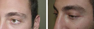 Eyebrow Before and after in Miami, FL, Paciente 36538
