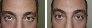 Eyebrow Before and after in Miami, FL, Paciente 36538
