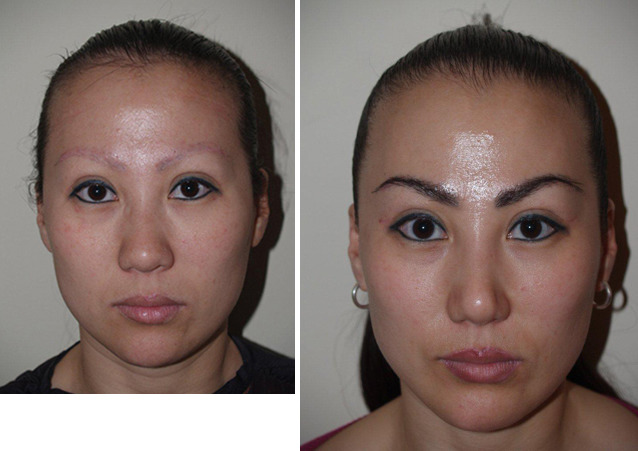 Eyebrow Before and after in Miami, FL, Paciente 36625