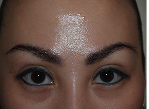 Eyebrow Before and after in Miami, FL, Paciente 36625