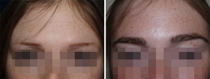 Eyebrow Before and after in Miami, FL, Paciente 36656