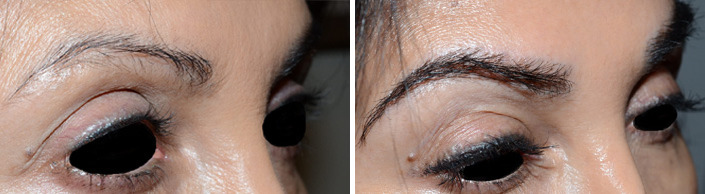 Eyebrow Before and after in Miami, FL, Paciente 36670