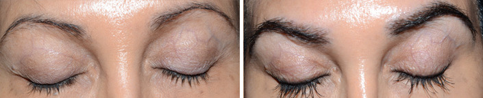 Eyebrow Hair Transplant Before and after in Miami, FL, Paciente 36670