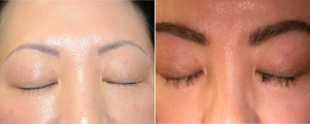 Eyebrow Hair Transplant Before and after in Miami, FL, Paciente 36703