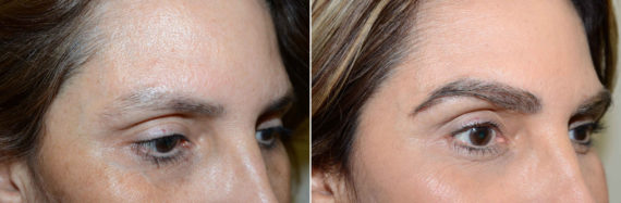 Eyebrow Before and after in Miami, FL, Paciente 58226