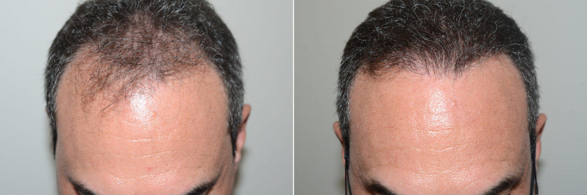 Hair Transplants for Men Before and after in Miami, FL, Paciente 118706