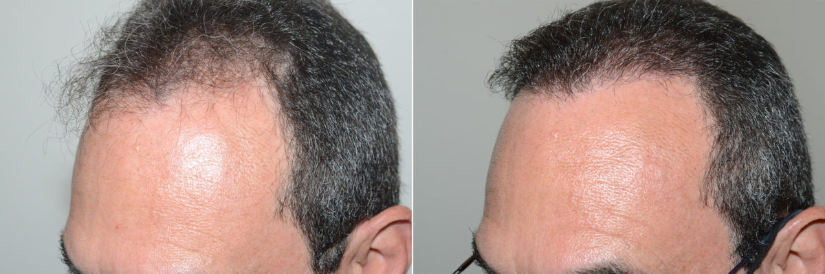 Hair Transplants for Men Before and after in Miami, FL, Paciente 118706
