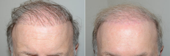 Reparative Hair Transplant Before and after in Miami, FL, Paciente 118745