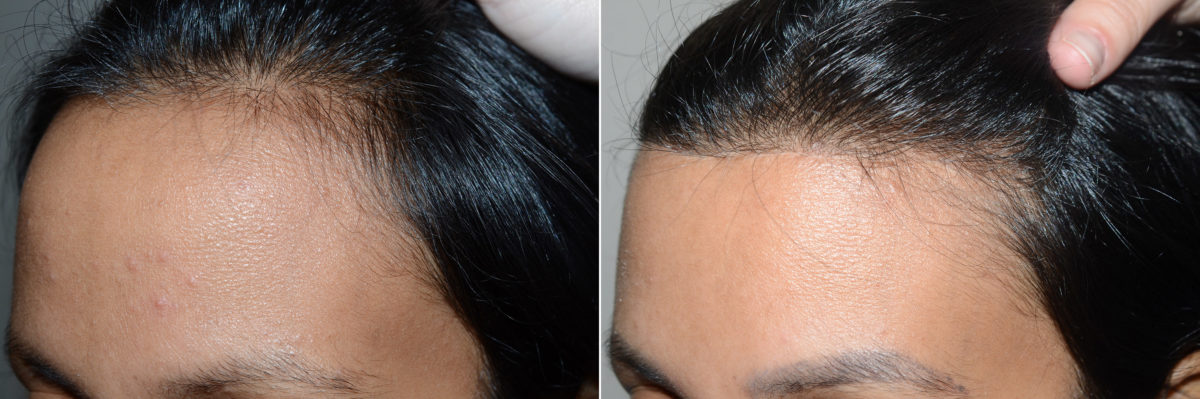 Forehead Reduction Surgery Before and after in Miami, FL, Paciente 118806