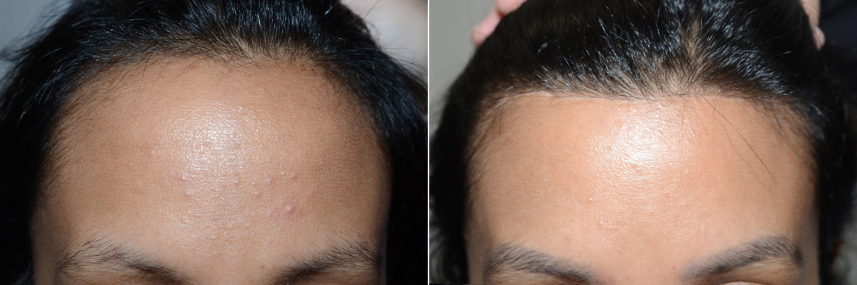 Hairline Advancement Before and after in Miami, FL, Paciente 118806