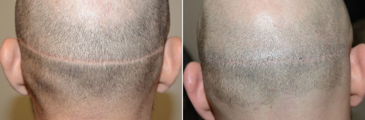 Reparative Hair Transplant Before and after in Miami, FL, Paciente 108183
