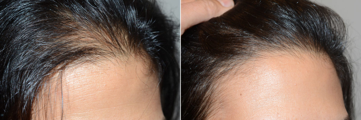 Hair Transplants for Women Before and after in Miami, FL, Paciente 118764