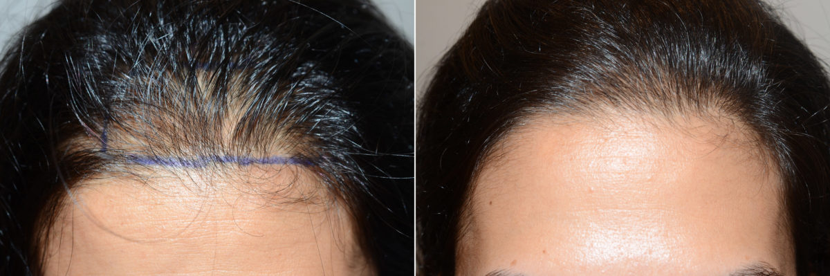 Hair Transplants for Women Before and after in Miami, FL, Paciente 118764
