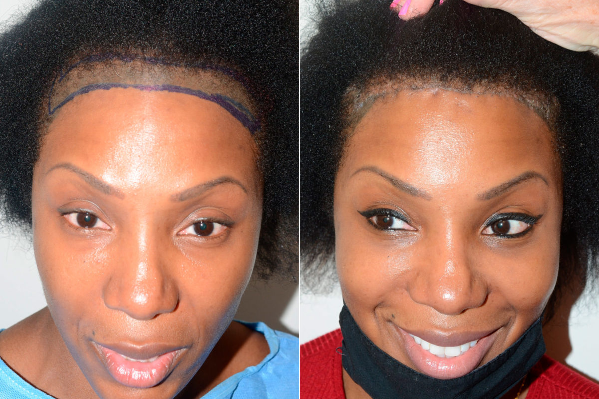 Forehead Reduction Surgery Before and after in Miami, FL, Paciente 118821