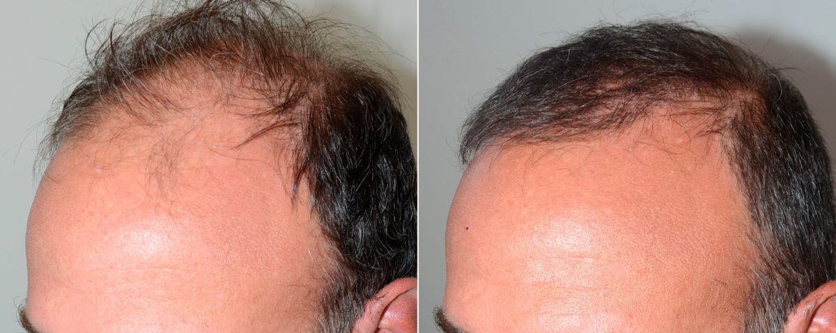 Hair Transplants for Men Before and after in Miami, FL, Paciente 118869