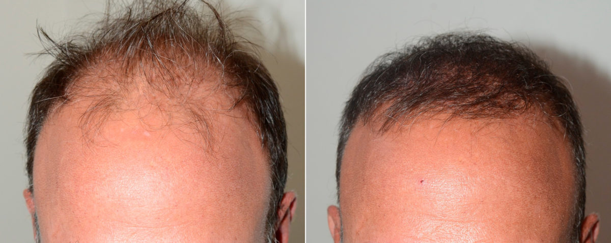 Hair Transplants for Men Before and after in Miami, FL, Paciente 118869