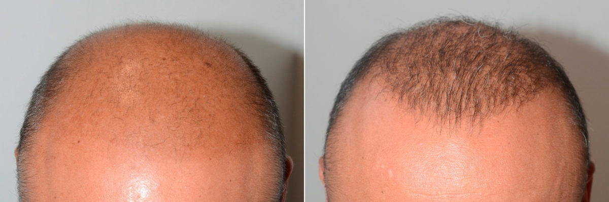 Body Hair Transplant Before and after in Miami, FL, Paciente 118885