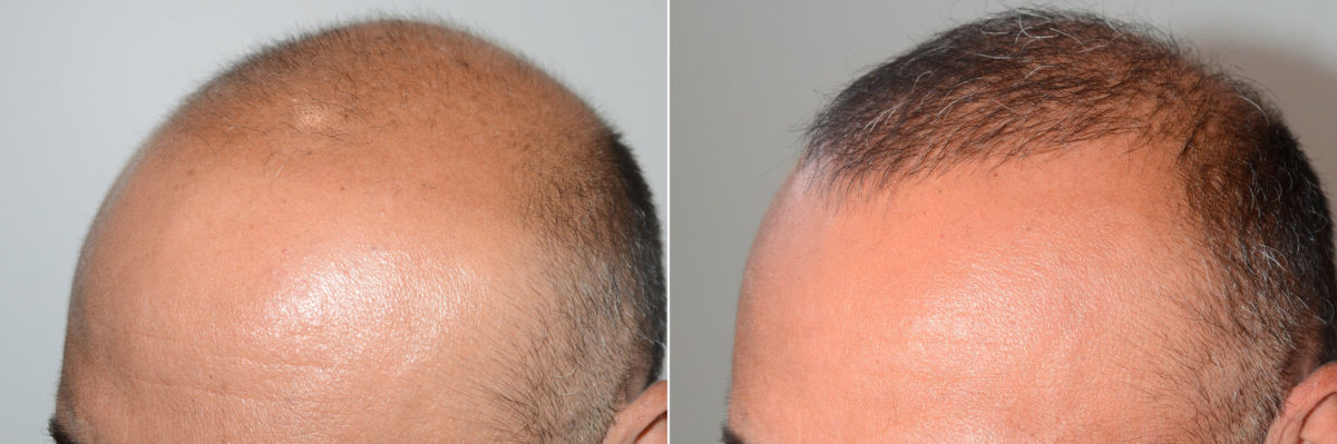 Body Hair Transplant Before and after in Miami, FL, Paciente 118885