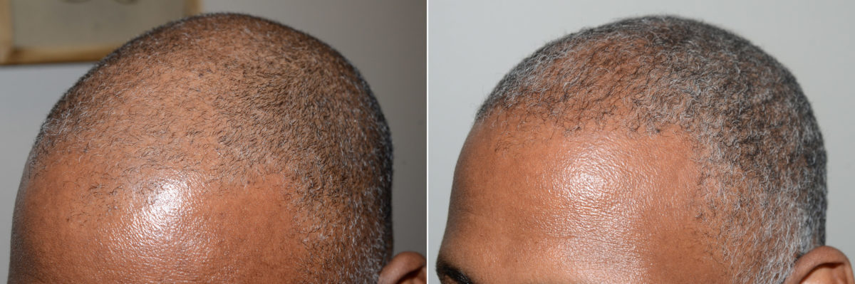 Hair Transplants for Men Before and after in Miami, FL, Paciente 118912