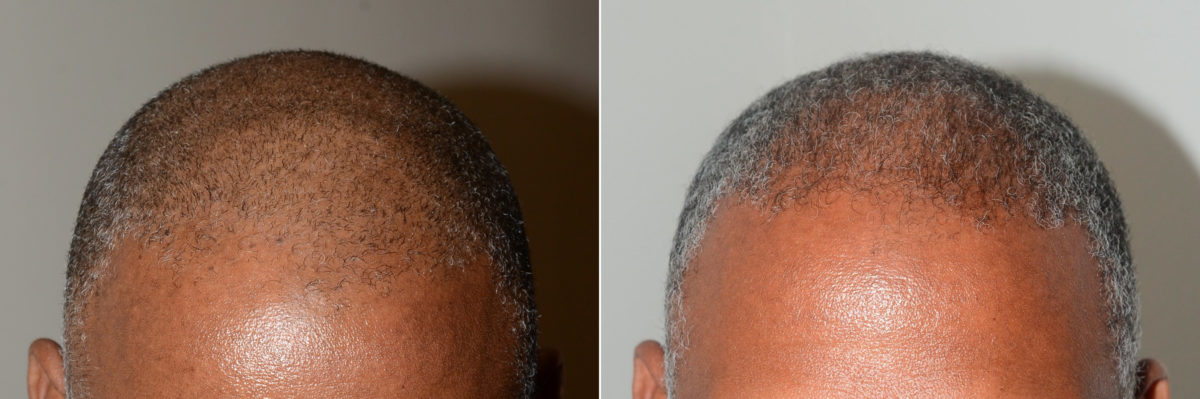 Hair Transplants for Men Before and after in Miami, FL, Paciente 118912