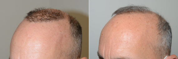 Reparative Hair Transplant Before and after in Miami, FL, Paciente 119189