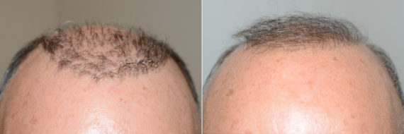 Reparative Hair Transplant Before and after in Miami, FL, Paciente 119189