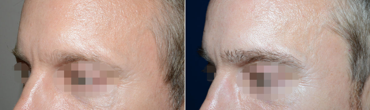 Eyebrow Before and after in Miami, FL, Paciente 119208