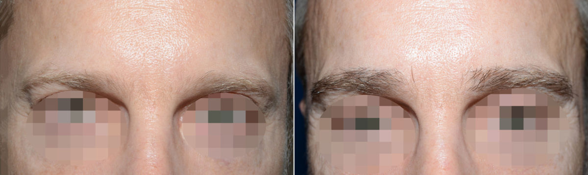 Eyebrow Hair Transplant Before and after in Miami, FL, Paciente 119208