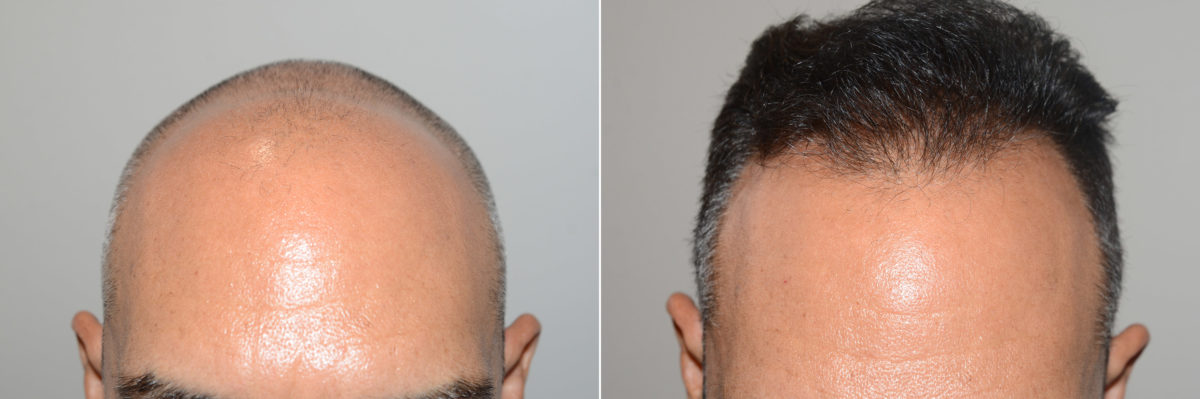 Hair Transplants for Men Before and after in Miami, FL, Paciente 119235